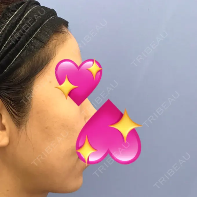 糸リフト / バッカルファット除去 / 脂肪吸引（顔） / メーラーファット除去 / ジョールファット除去 / ボトックス（エラ・小顔） / その他（輪郭） 湘南美容クリニック 秋葉原院 DAY 350 メイン用