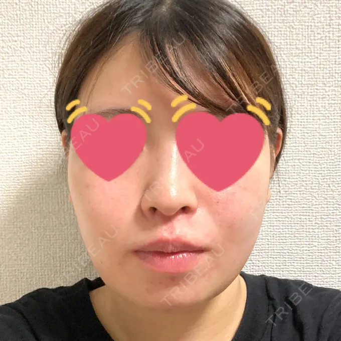 脂肪吸引（顔） / 脂肪冷却（輪郭） WOM CLINIC GINZA （ワム クリニック ギンザ） DAY 16 メイン用