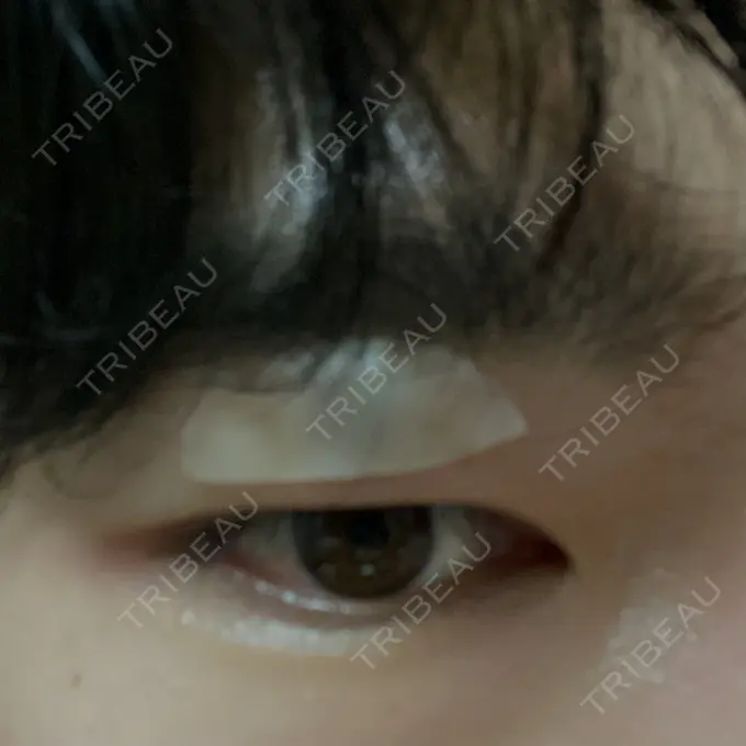 ほくろ・いぼ除去レーザー（肌） エースクリニック 大阪梅田HEPナビオ院 DAY 5 メイン用