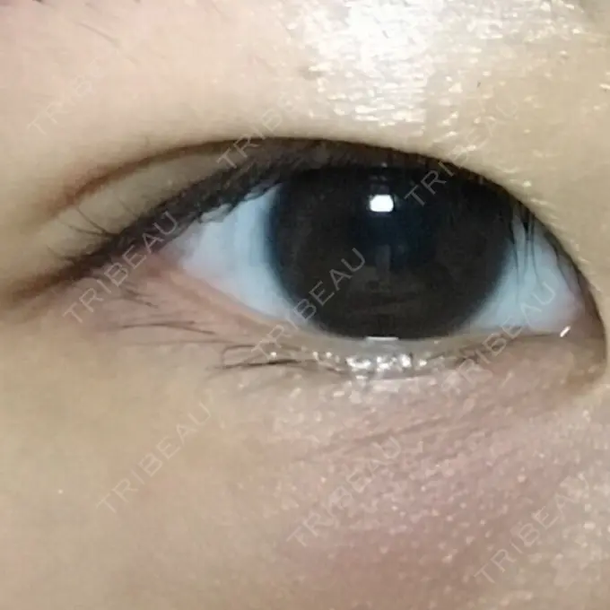 二重埋没 湘南美容クリニック 銀座院 AFTER メイン用