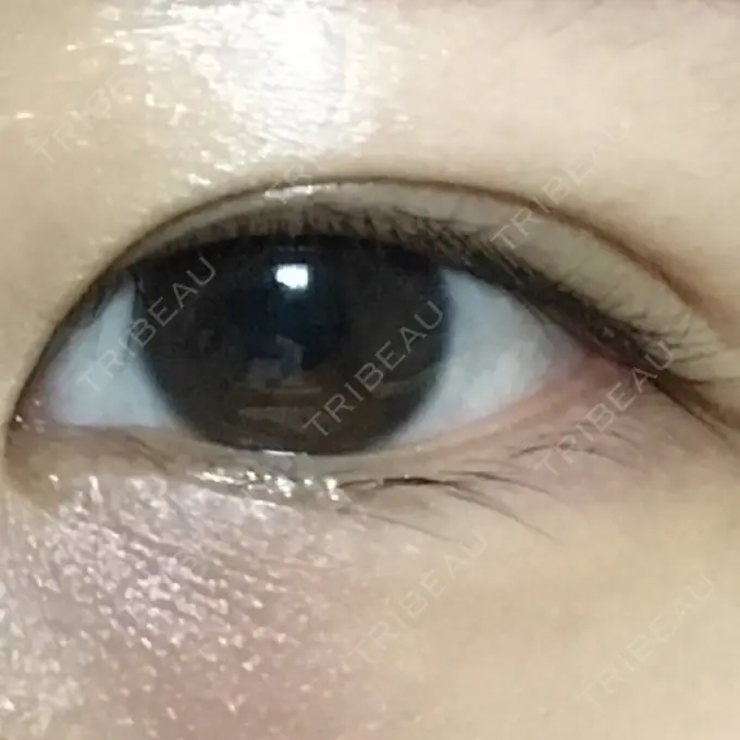 二重埋没 湘南美容クリニック 銀座院 DAY 153 メイン用