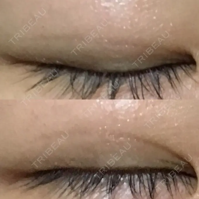 二重埋没 湘南美容クリニック 銀座院 DAY 153 メイン用