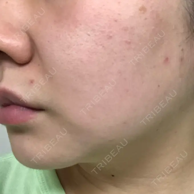 ほくろ・いぼ切除（肌） 吉祥寺アイビークリニック DAY 3 メイン用