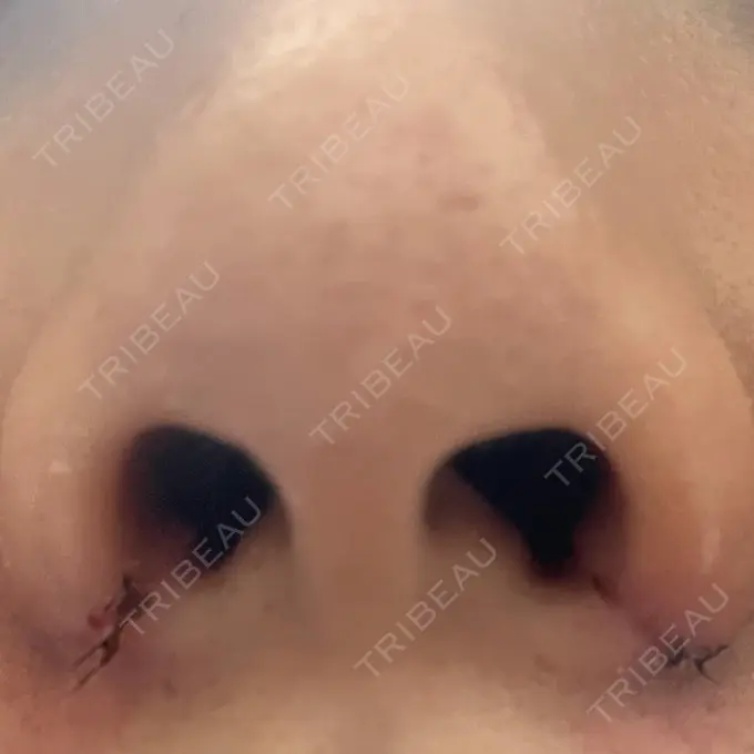 小鼻縮小（切開） / ヒアルロン酸注入（鼻） / ボトックス（エラ・小顔） / その他（鼻） 吉祥寺アイビークリニック DAY 4 メイン用