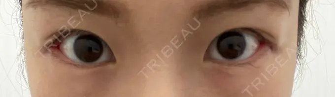 目尻切開 TCB東京中央美容外科 金沢院 DAY 8 メイン用