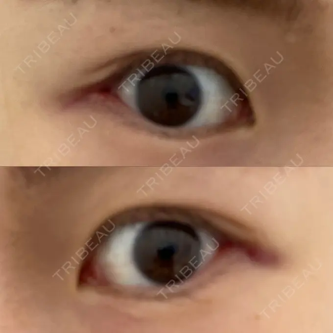 目尻切開 TCB東京中央美容外科 金沢院 DAY 8 メイン用