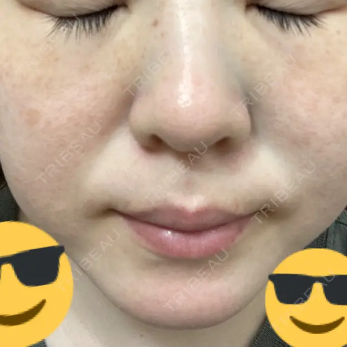 ピコレーザートーニング（美白・肝斑） フローラクリニック AFTER メイン用