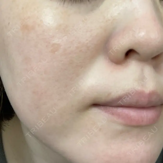 ピコレーザートーニング（美白・肝斑） フローラクリニック DAY 0 メイン用