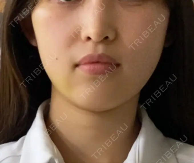 糸リフト / 脂肪吸引（顔） / ボトックス（エラ・小顔） HAAB×DREAM BEAUTY CLINIC 東京本院 DAY 13 メイン用