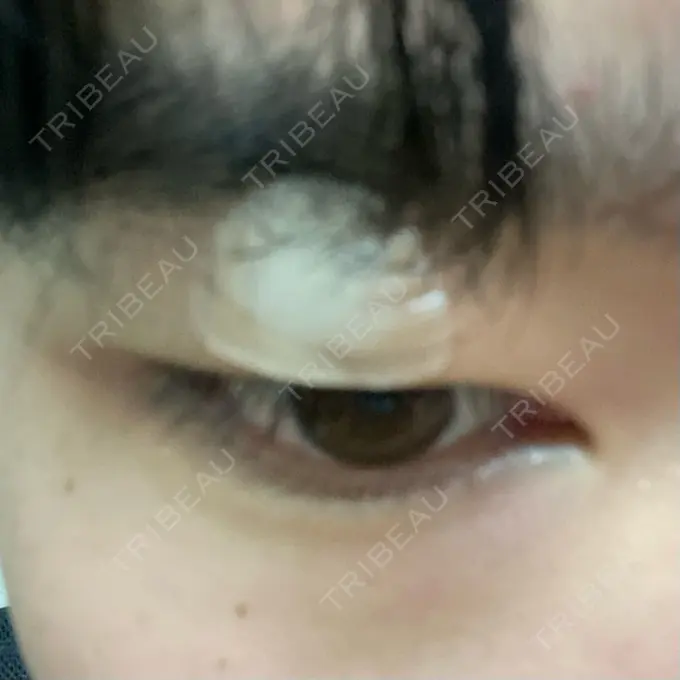 ほくろ・いぼ除去レーザー（肌） エースクリニック 大阪梅田HEPナビオ院 DAY 7 メイン用