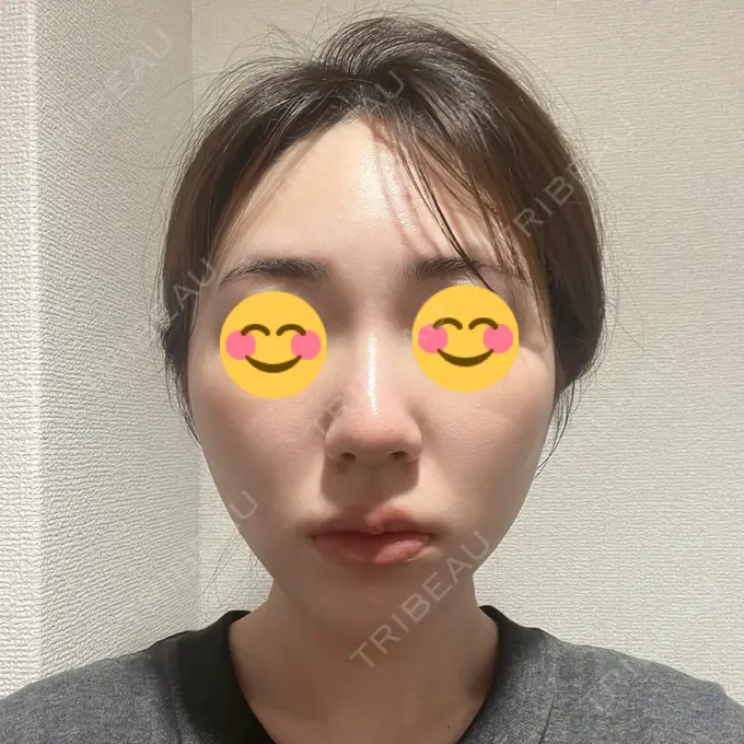 糸リフト / バッカルファット除去 大阪TAクリニック DAY 4 メイン用