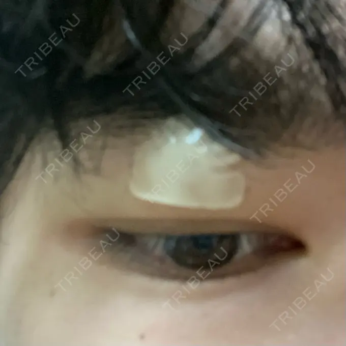 ほくろ・いぼ除去レーザー（肌） エースクリニック 大阪梅田HEPナビオ院 DAY 8 メイン用