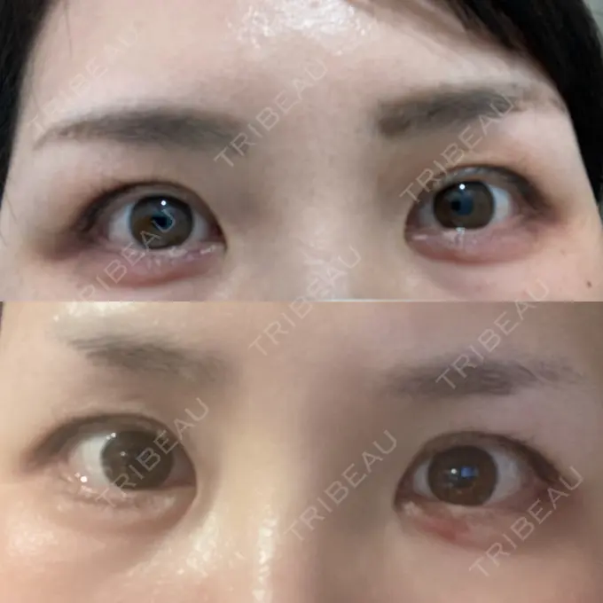 ヒアルロン酸注入（涙袋） TCB東京中央美容外科 金沢院 AFTER メイン用