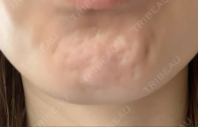 ボトックス（あご） TCB東京中央美容外科 千葉駅前院 DAY 0 メイン用