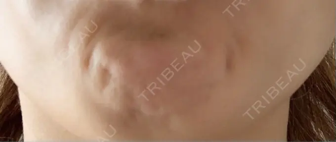 ボトックス（あご） TCB東京中央美容外科 千葉駅前院 DAY 1 メイン用