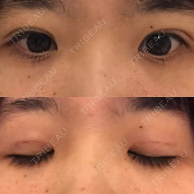 二重埋没 / 眼瞼下垂（非切開） WOM CLINIC GINZA （ワム クリニック ギンザ） DAY 7 メイン用