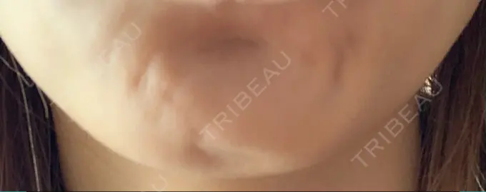 ボトックス（あご） TCB東京中央美容外科 千葉駅前院 DAY 2 メイン用