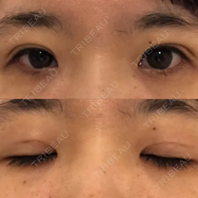 二重埋没 / 眼瞼下垂（非切開） WOM CLINIC GINZA （ワム クリニック ギンザ） DAY 8 メイン用