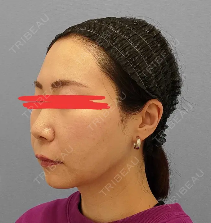 糸リフト / 脂肪吸引（顔） / メーラーファット除去 湘南美容クリニック 秋葉原院 DAY 35 メイン用