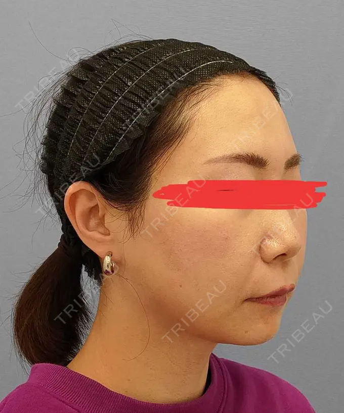 糸リフト / 脂肪吸引（顔） / メーラーファット除去 湘南美容クリニック 秋葉原院 DAY 35 メイン用