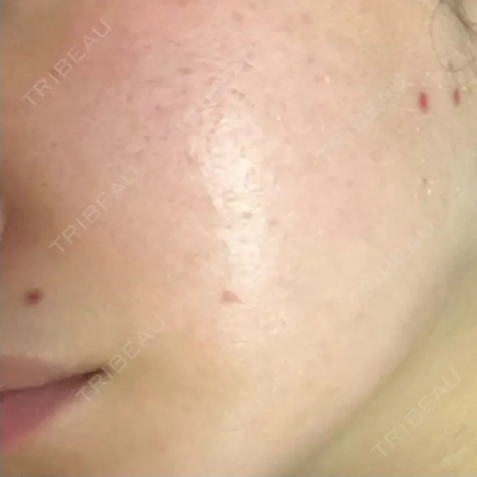 ほくろ・いぼ切除（肌） 吉祥寺アイビークリニック AFTER メイン用