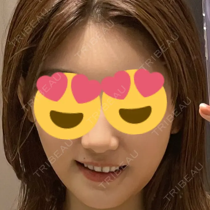 脂肪溶解注射（顔） 吉祥寺アイビークリニック AFTER メイン用