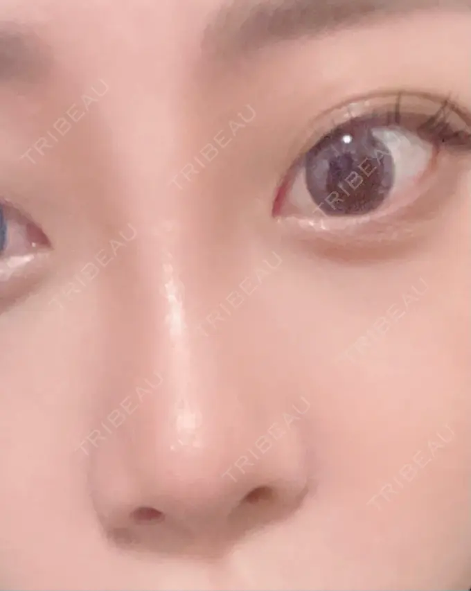 小鼻縮小（切開） / ヒアルロン酸注入（鼻） / ボトックス（エラ・小顔） / その他（鼻） 吉祥寺アイビークリニック AFTER メイン用