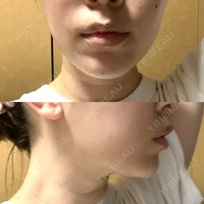 糸リフト / 脂肪吸引（顔） 湘南美容クリニック 長野院 DAY 39 メイン用