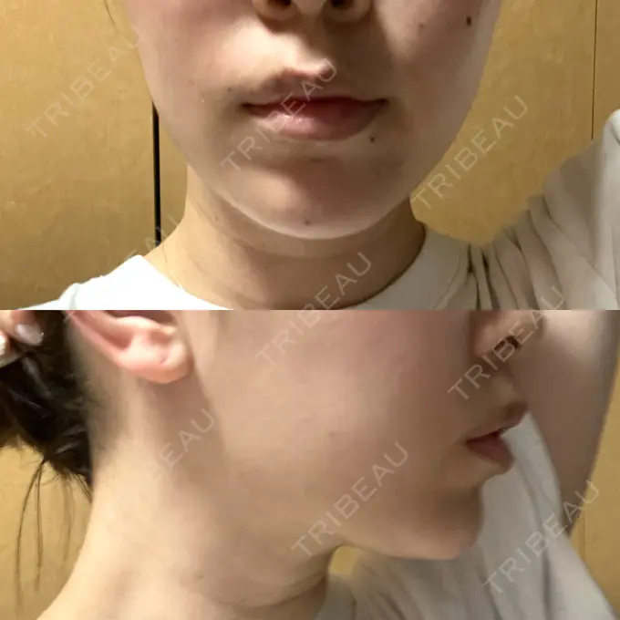 糸リフト / 脂肪吸引（顔） 湘南美容クリニック 長野院 AFTER メイン用