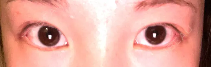 目尻切開 TCB東京中央美容外科 金沢院 DAY 15 メイン用