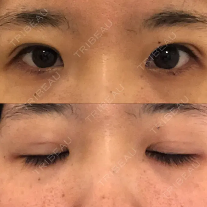 二重埋没 / 眼瞼下垂（非切開） WOM CLINIC GINZA （ワム クリニック ギンザ） DAY 11 メイン用