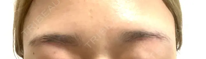 上まぶたの脂肪取り / 眉下切開 e:Top clinic（イートップクリニック） AFTER メイン用