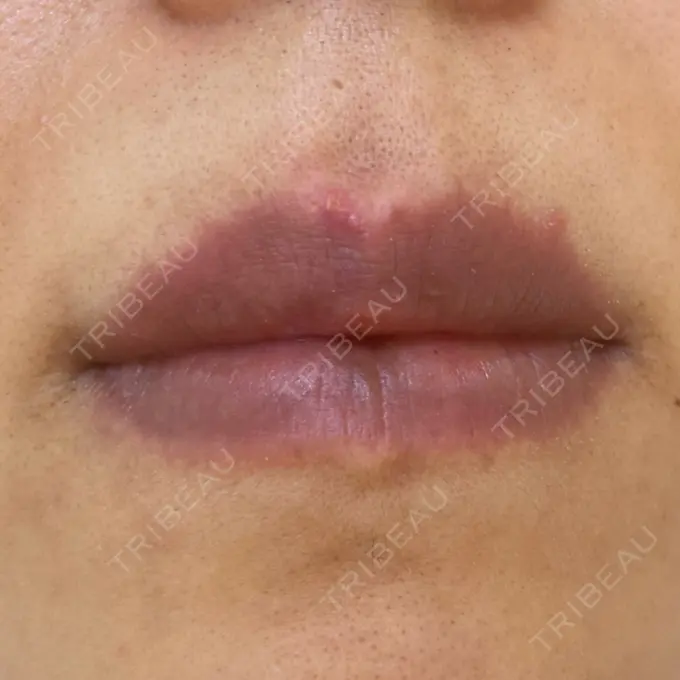 アートメイク（唇） エールクリニック 大阪心斎橋 DAY 10 メイン用