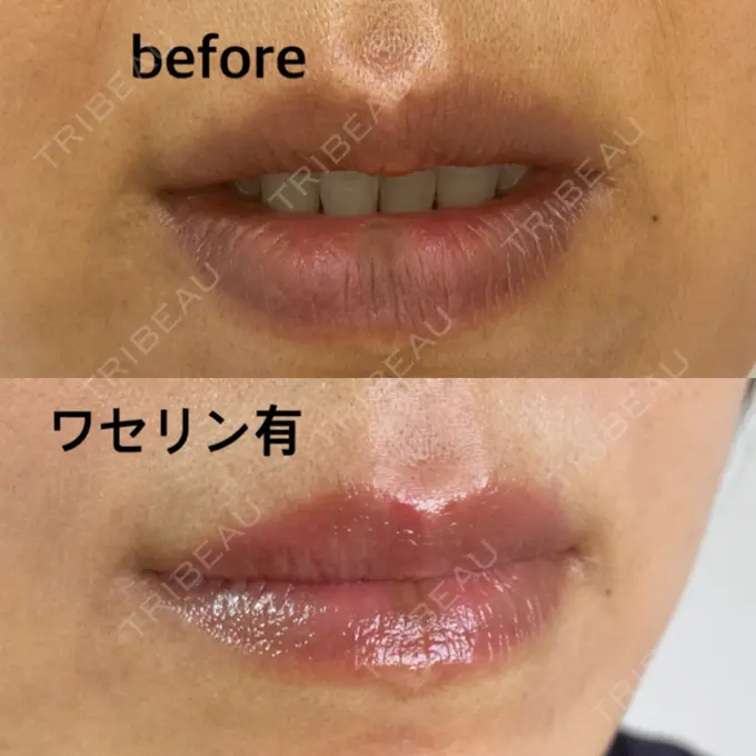 アートメイク（唇） エールクリニック 大阪心斎橋 DAY 18 メイン用