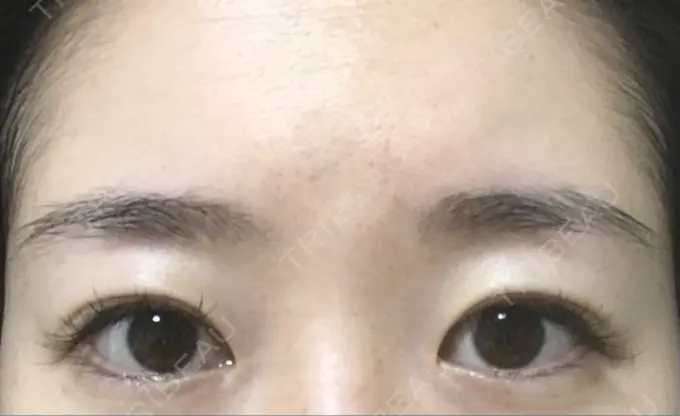 二重切開 有楽町高野美容クリニック AFTER メイン用