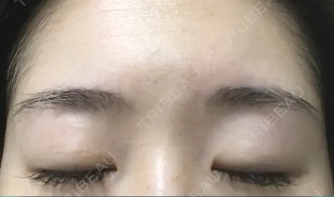 二重切開 有楽町高野美容クリニック DAY 243 メイン用