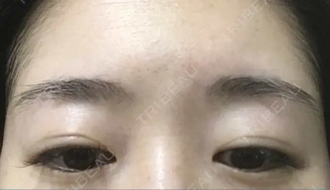 二重切開 有楽町高野美容クリニック DAY 243 メイン用