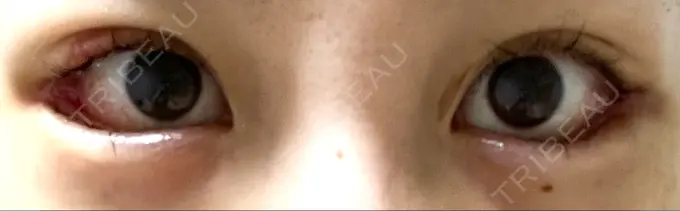 目尻切開 / タレ目形成・グラマラスライン（切開） / 目尻靭帯移動 BIOTOPE CLINIC 【ビオトープクリニック】 DAY 15 メイン用