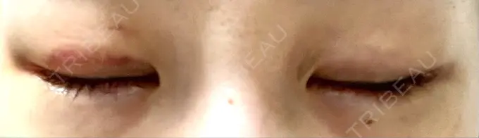 目尻切開 / タレ目形成・グラマラスライン（切開） / 目尻靭帯移動 BIOTOPE CLINIC 【ビオトープクリニック】 DAY 15 メイン用