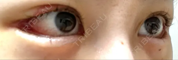 目尻切開 / タレ目形成・グラマラスライン（切開） / 目尻靭帯移動 BIOTOPE CLINIC 【ビオトープクリニック】 DAY 15 メイン用