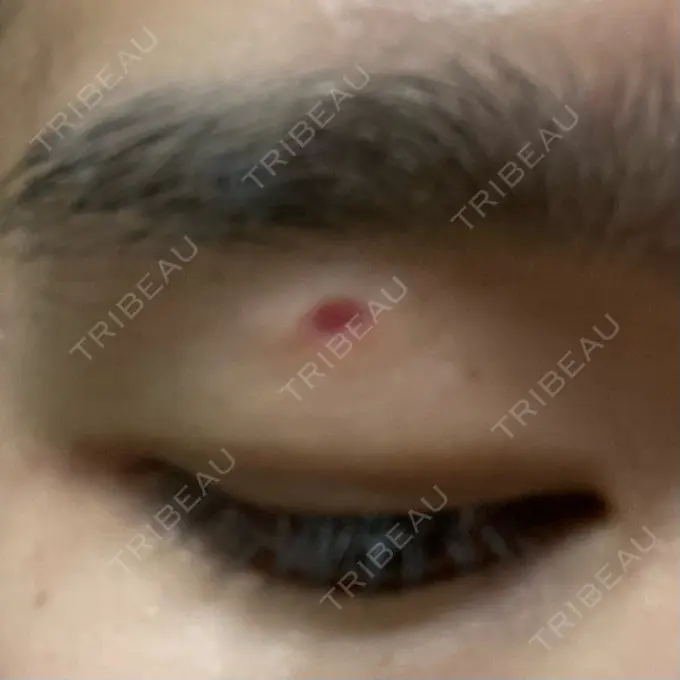 ほくろ・いぼ除去レーザー（肌） エースクリニック 大阪梅田HEPナビオ院 DAY 15 メイン用