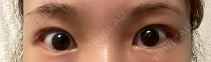 目尻切開 TCB東京中央美容外科 金沢院 DAY 17 メイン用