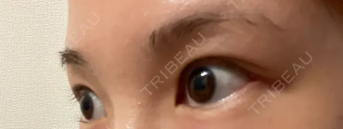 目尻切開 TCB東京中央美容外科 金沢院 DAY 17 メイン用