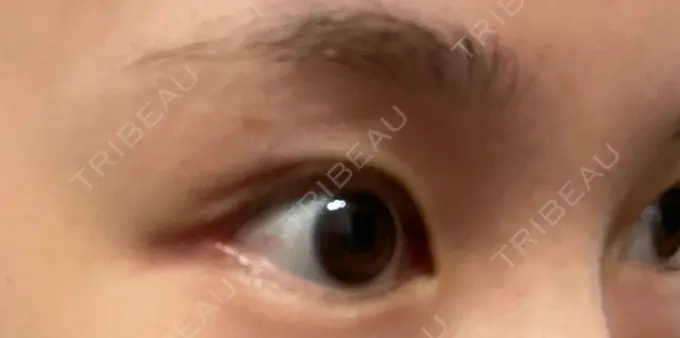 目尻切開 TCB東京中央美容外科 金沢院 DAY 17 メイン用