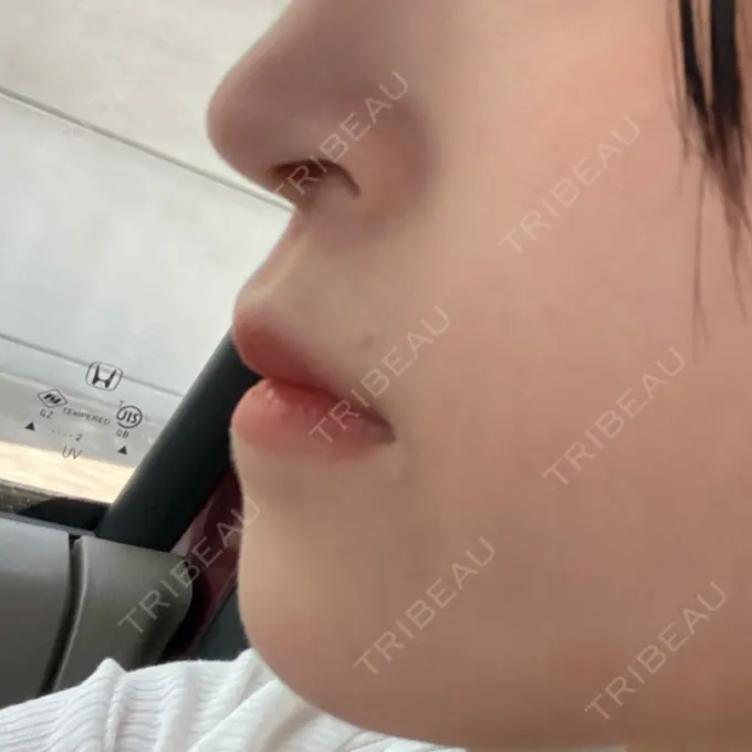 ボトックス（人中） Rosa Beauty Clinic DAY 2 メイン用