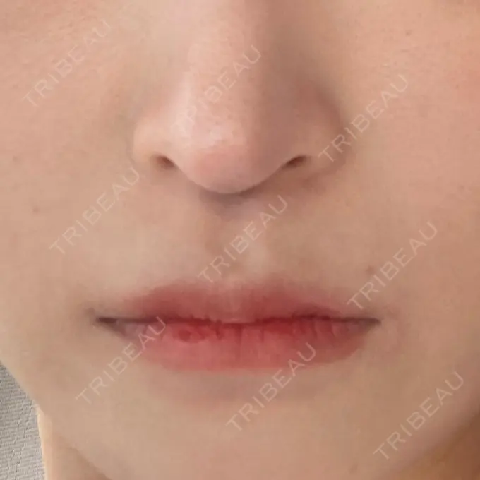 ボトックス（人中） Rosa Beauty Clinic DAY 2 メイン用