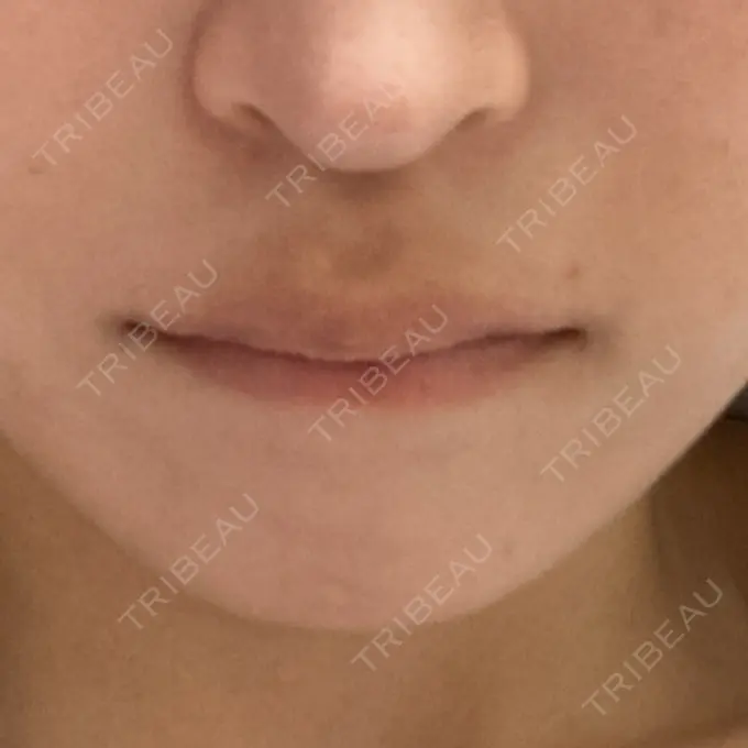 ボトックス（人中） Rosa Beauty Clinic DAY 4 メイン用