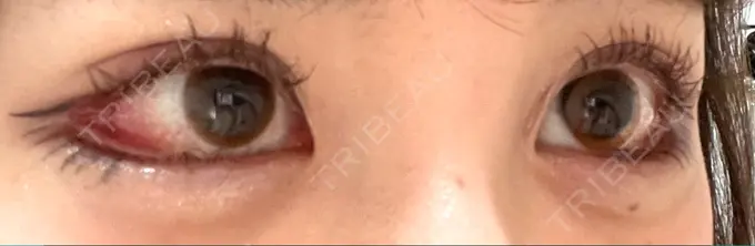 目尻切開 / タレ目形成・グラマラスライン（切開） / 目尻靭帯移動 BIOTOPE CLINIC 【ビオトープクリニック】 DAY 16 メイン用