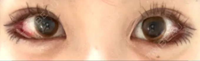 目尻切開 / タレ目形成・グラマラスライン（切開） / 目尻靭帯移動 BIOTOPE CLINIC 【ビオトープクリニック】 DAY 16 メイン用