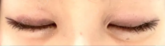 目尻切開 / タレ目形成・グラマラスライン（切開） / 目尻靭帯移動 BIOTOPE CLINIC 【ビオトープクリニック】 DAY 16 メイン用